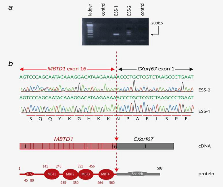 Validation of MBTD1?CXorf67 fusion in ESS. 