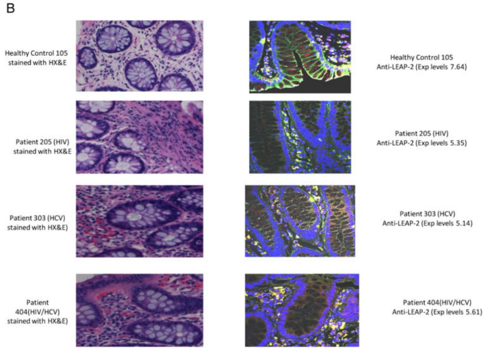 comparative evaluation of LEAP-2 expression in colonic tissues from a healthy control subject and HIV-monoinfected patients. 